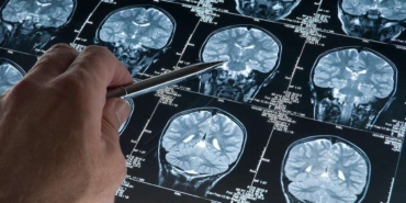 Yaşlı Erkeklerde Demans Riskini Artıran Gen Bulundu